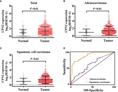 Carboxypeptidase N2 as a Novel Diagnostic and Prognostic Biomarker for Lung Adenocarcinoma